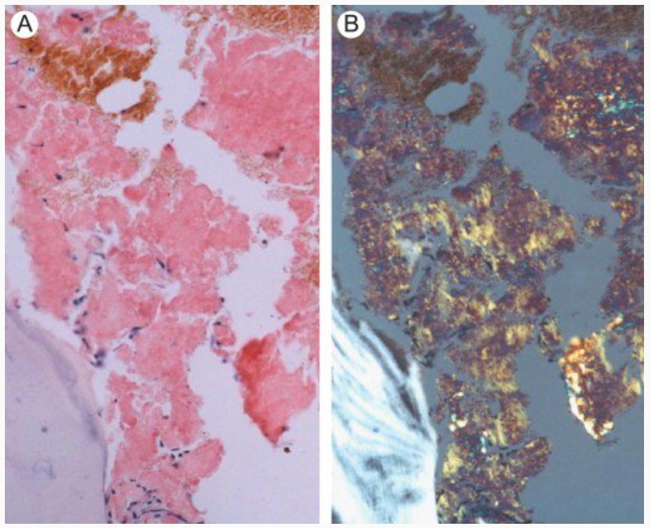 aspirate医学_aspirate_aspirate词根