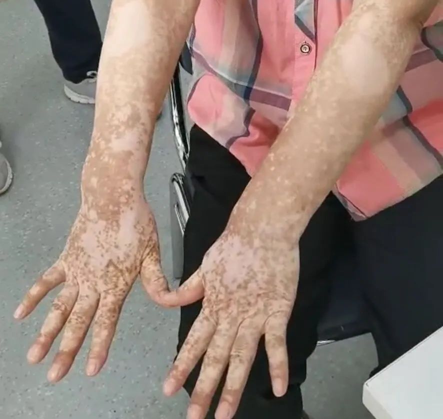 肤如凝脂在80_肤如凝脂_肤如凝脂的凝脂是什么