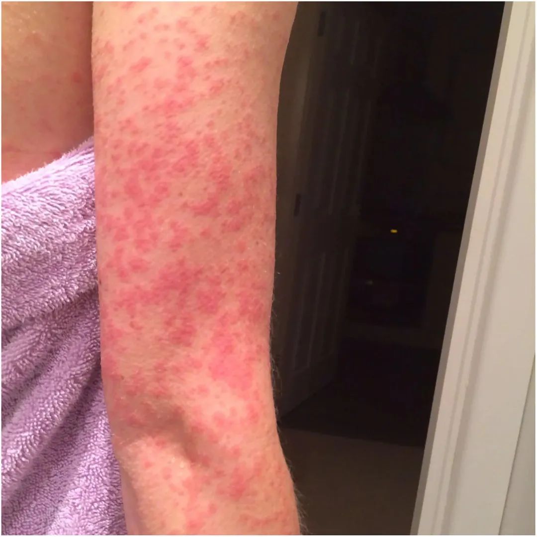 lesions_lesion是什么意思_lesions是什么意思