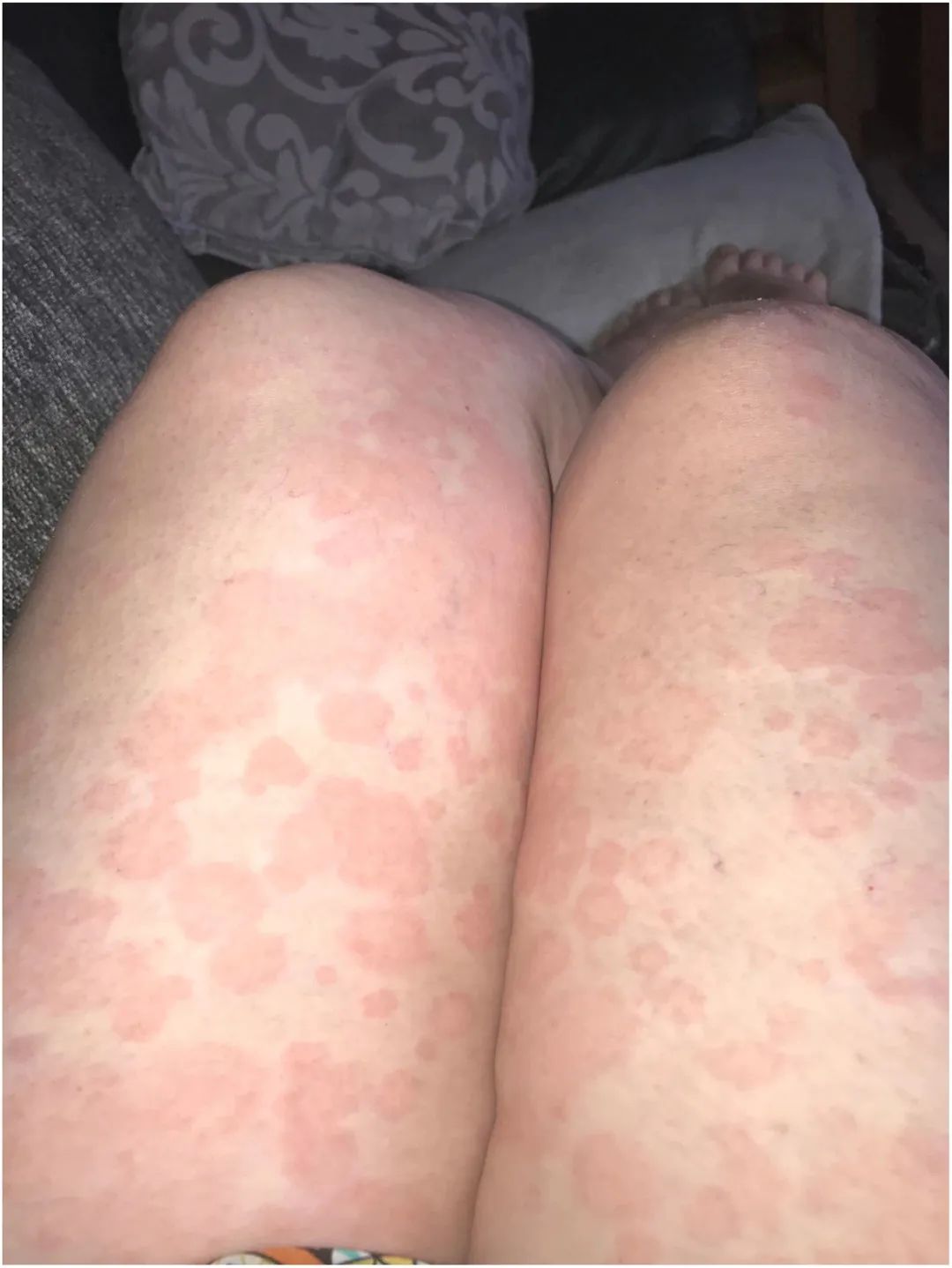 lesions是什么意思_lesion是什么意思_lesions