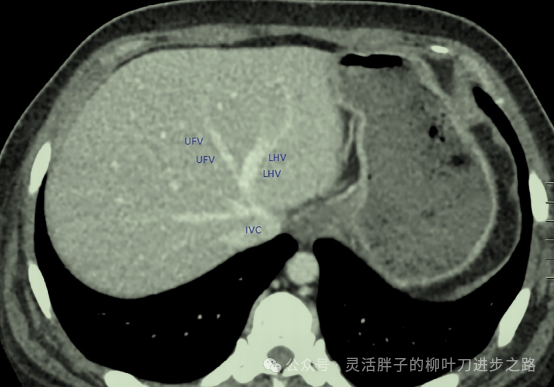 fissure_fissure怎么读_fissure是什么意思